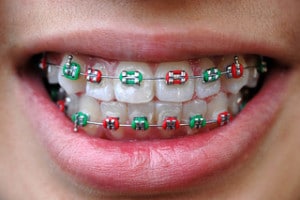 Wpid-ortho-mouth-coloredbands