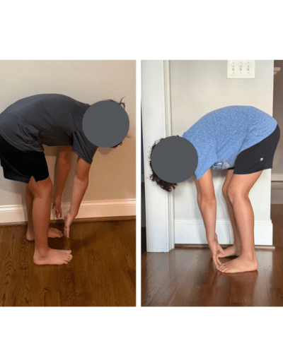 Cole’s tongue-tie success story touching toes before and after