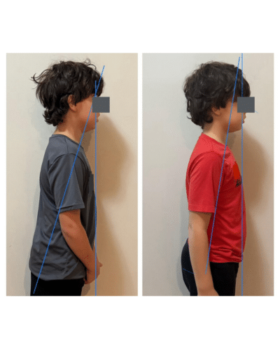 Cole’s tongue-tie success story before and after standing up